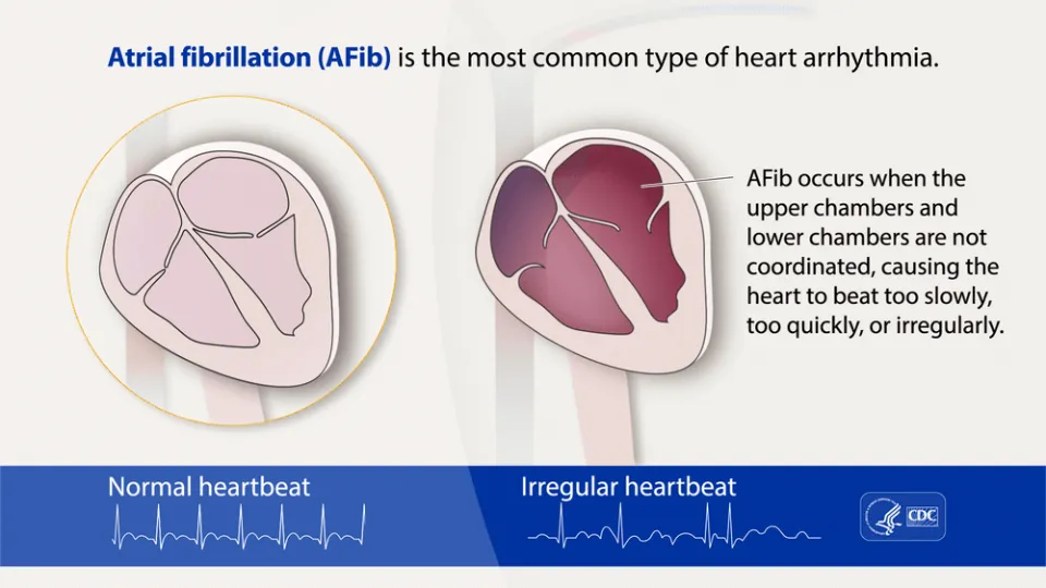 How Dangerous is Afib in Elderly: Alert!