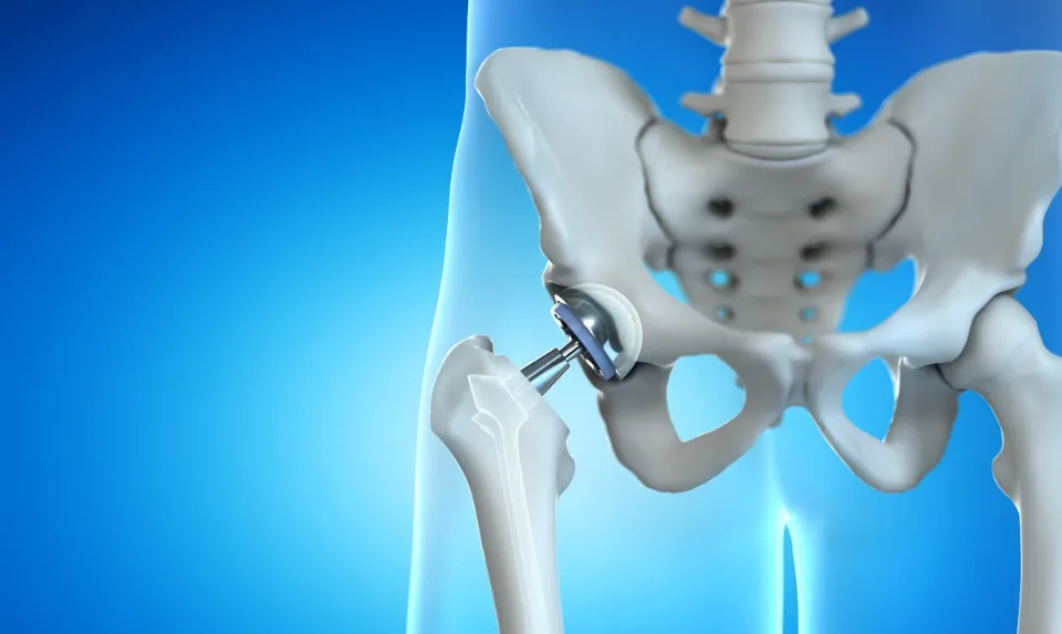 How Do You Fix a Loose Hip Replacement? (Solved)
