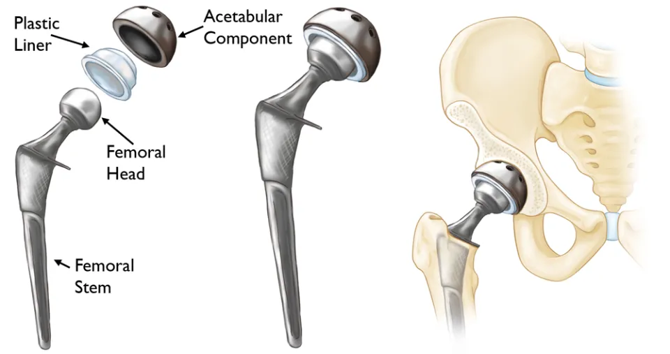 How Much Does a Titanium Hip Replacement Weigh?