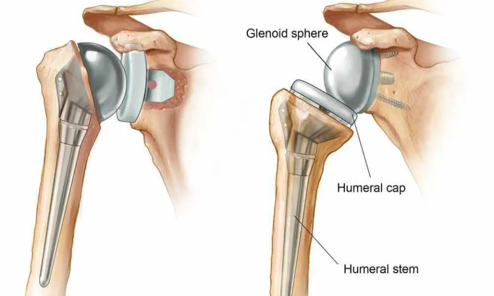 After Shoulder Replacement: How Long to Therapy?