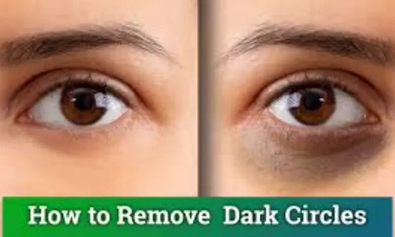 How to Get Rid of Dark Circles? 6 Causes & Treatments