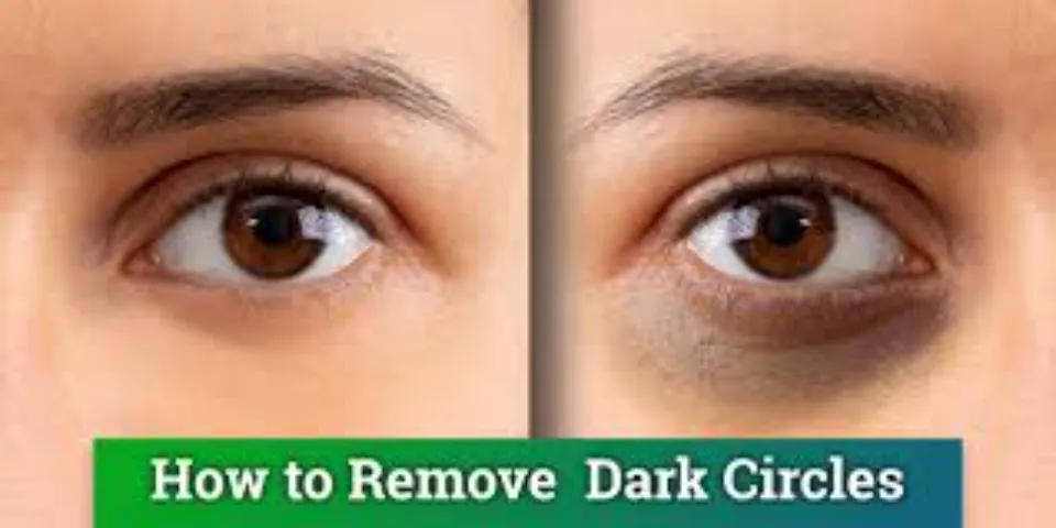 How to Get Rid of Dark Circles? 6 Causes & Treatments