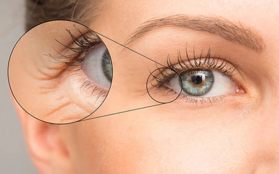 How to Get Rid of Under-eye Wrinkles? 8 Ways
