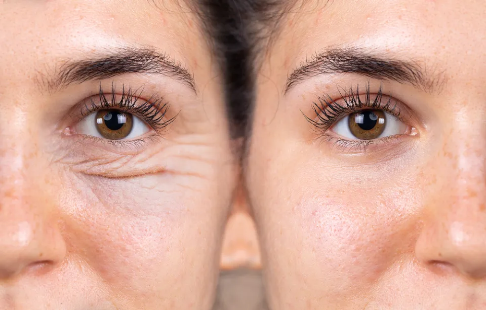 How to Get Rid of Under-eye Wrinkles? 8 Ways